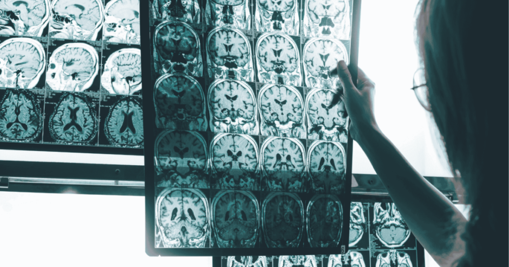 Un índice cerebral mejora la detección del Alzheimer y subraya que la enfermedad empieza años antes