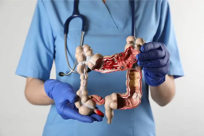 Pacientes con Crohn exponen retrasos en Alto Costo y presionan por respuestas oficiales
