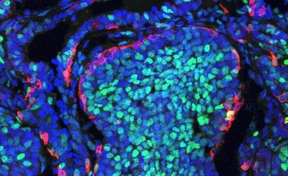 Alerta de la OMS expone el costo de la desigualdad: el cáncer mata 26 mil personas al día mientras persisten brechas de acceso